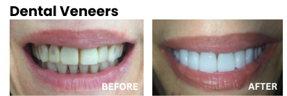 dental veneers before and after
