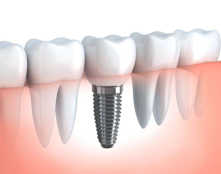dental implant screw illustration