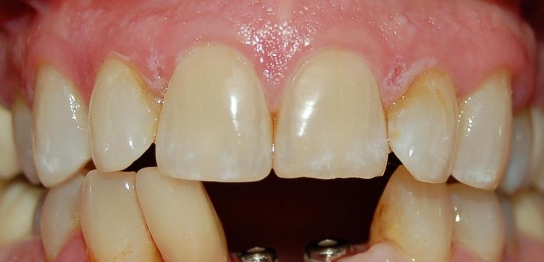 Advanced Gum Disease treatment | Rockville, MD | Gladnick Family & Cosmetic Dentistry