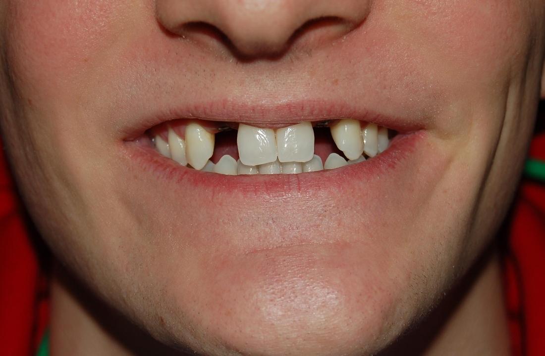 Patient with missing teeth before dental implants in Rockville, MD