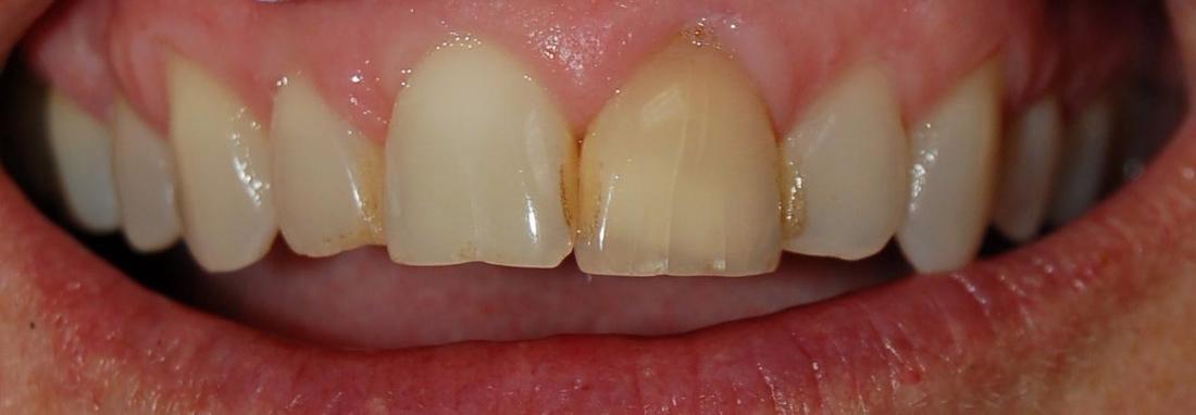 Before yellowed teeth | Rockville, MD | Gladnick Family & Cosmetic Dentistry