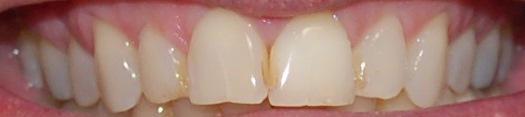 Internal-Bleaching-After-Image